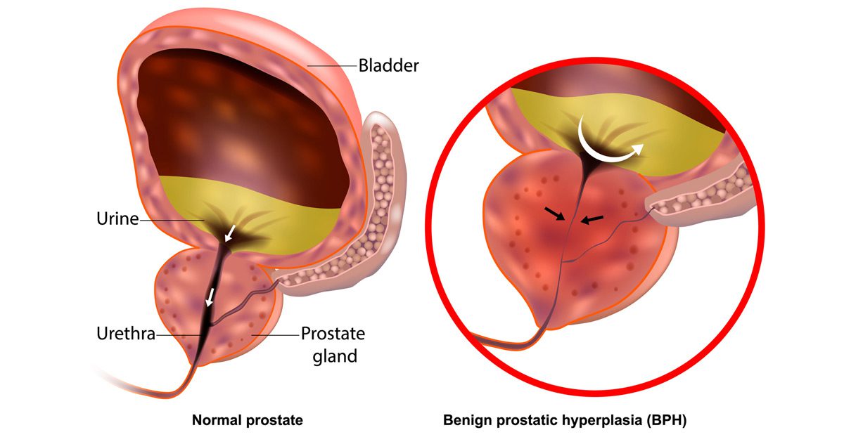 Benign-prostatic-hyperplasia-(BPH)-vs.-normal-prostate-illustration Benign-prostatic-hyperplasia-(BPH)-vs.-normal-prostate-illustration