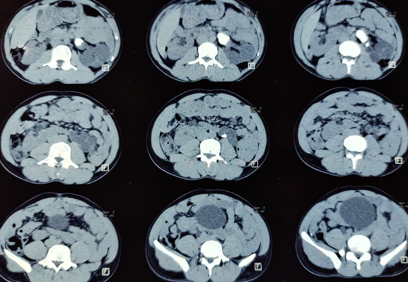 CT-scan-of-pelvi-ureteric-junction CT-scan-of-pelvi-ureteric-junction