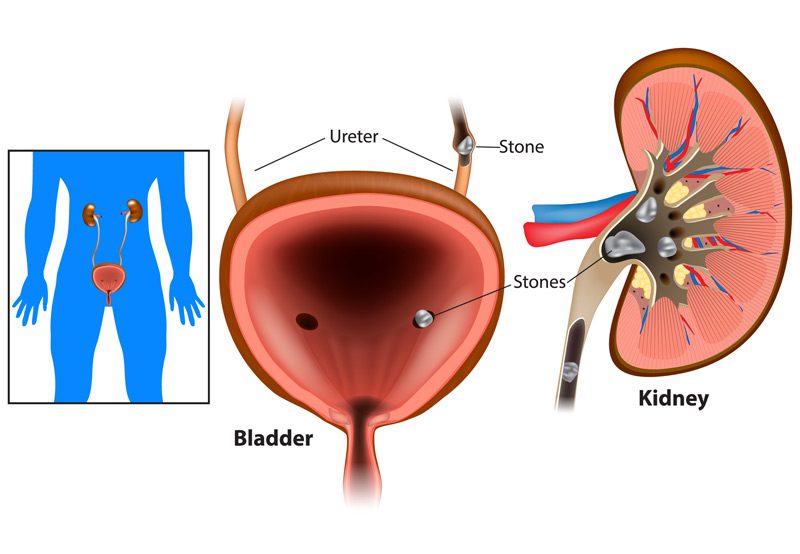 Concept-of-a-renal-stones-blocking-the-urinary-tract Concept-of-a-renal-stones-blocking-the-urinary-tract