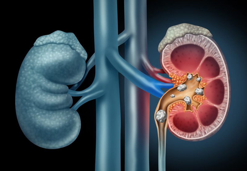 Human-kidney-stones-medical-concept Human-kidney-stones-medical-concept
