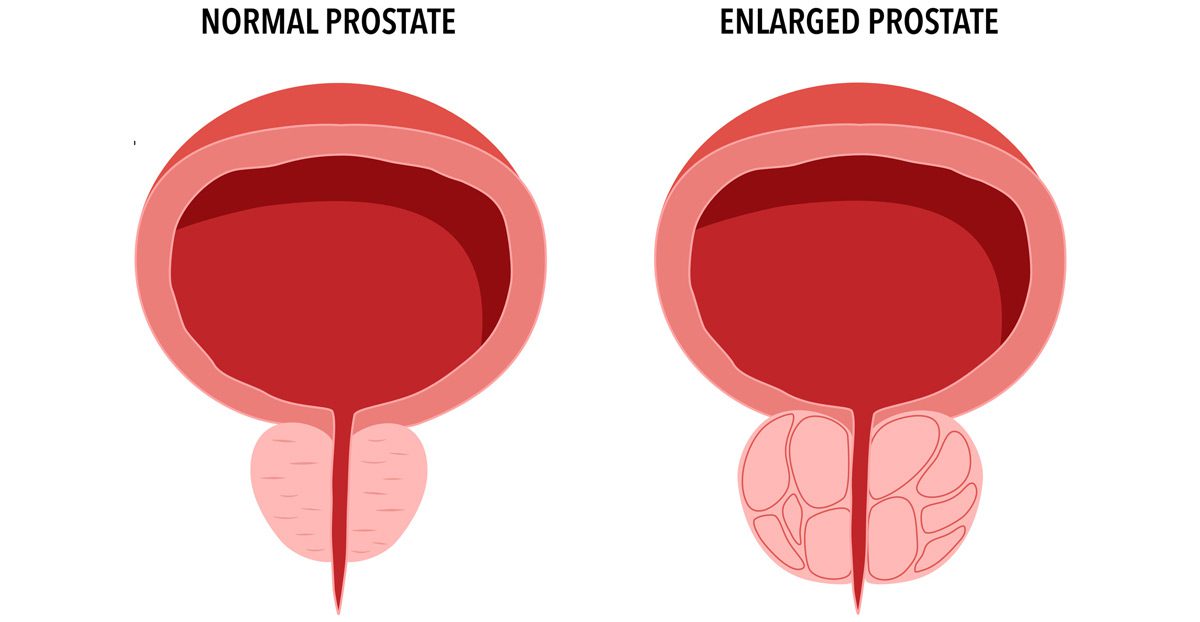 Illustration-of-prostate-gland Illustration-of-prostate-gland