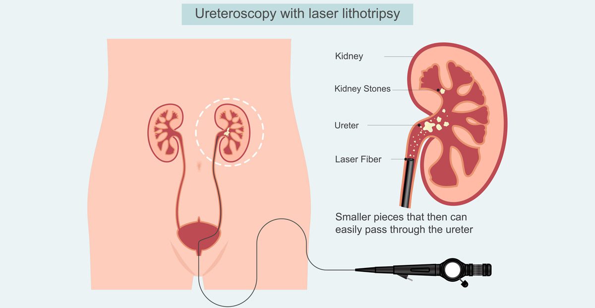 Illustration-of-ureteroscopy-with-laser-lithotripsy-procedure Illustration-of-ureteroscopy-with-laser-lithotripsy-procedure
