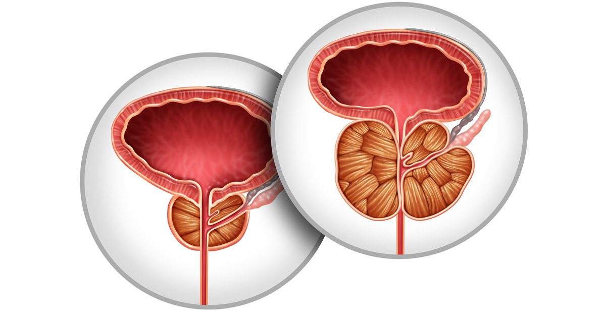 Illustration-showing-an-enlarged-prostate