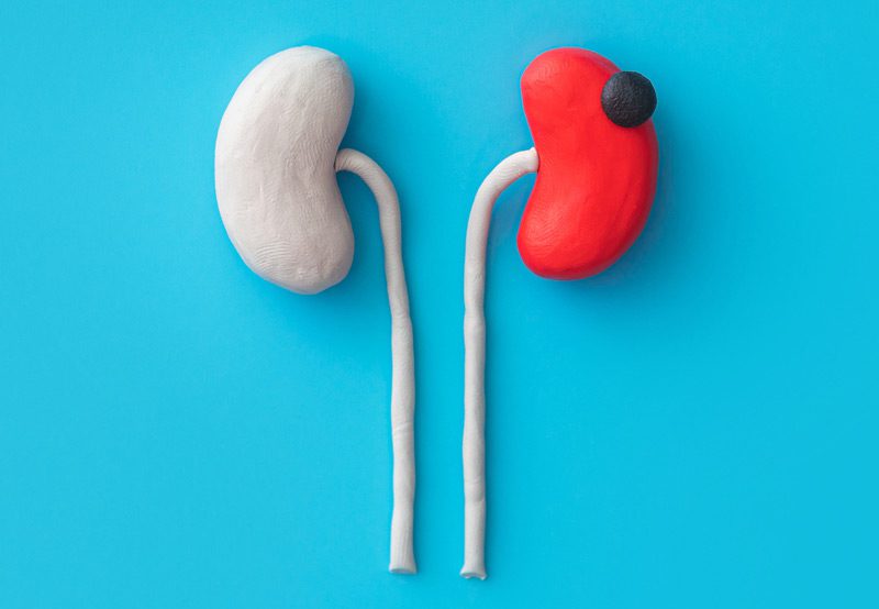 Illustrative-concept-of-kidney-disease Illustrative-concept-of-kidney-disease