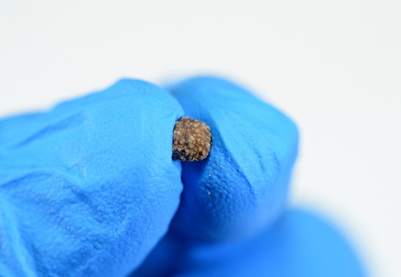 Irregular-brown-kidney-stones-after-surgery Irregular-brown-kidney-stones-after-surgery
