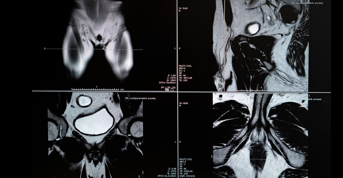 MRI-image-of-prostate-gland