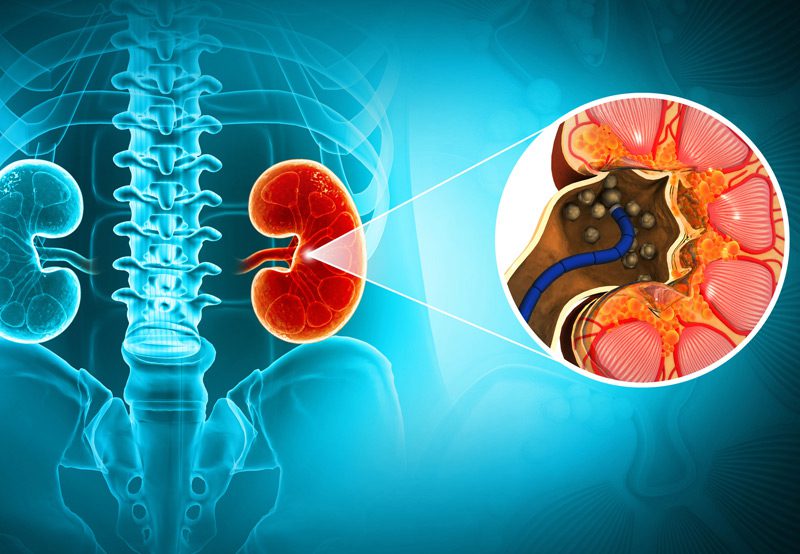 Medical-concept-of-kidney-stone-disease Medical-concept-of-kidney-stone-disease