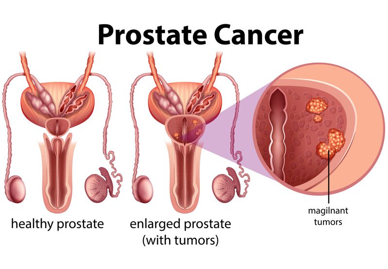 Prostate-cancer-medical-illustration Prostate-cancer-medical-illustration