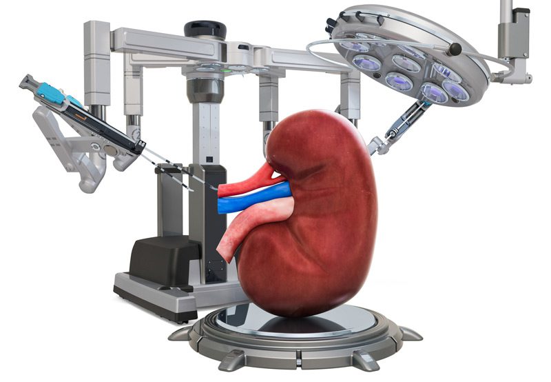 Retroperitoneal-port-placement-in-robotic-kidney-surgery Retroperitoneal-port-placement-in-robotic-kidney-surgery