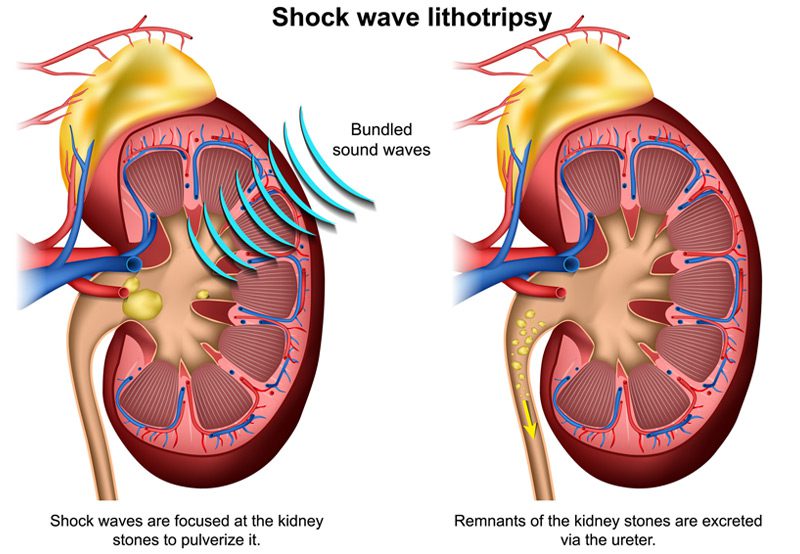 Shock-wave-lithotripsy-for-kidney-stones