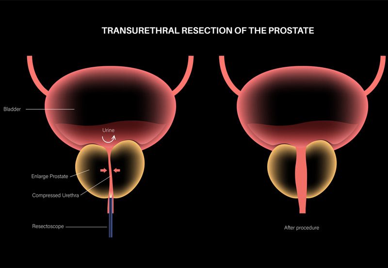 Transurethral-resection-of-the-prostate Transurethral-resection-of-the-prostate