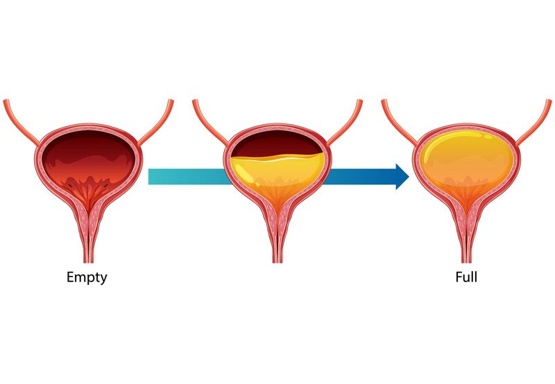Ureteral-obstruction-concept Ureteral-obstruction-concept