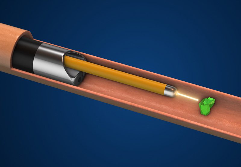 Ureteroscopy-laser-lithotripsy-procedure-for-breaking-kidney-stones Ureteroscopy-laser-lithotripsy-procedure-for-breaking-kidney-stones