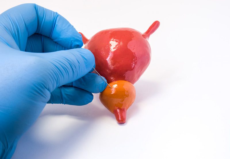 Urologist-holding-needle-for-prostate-biopsy