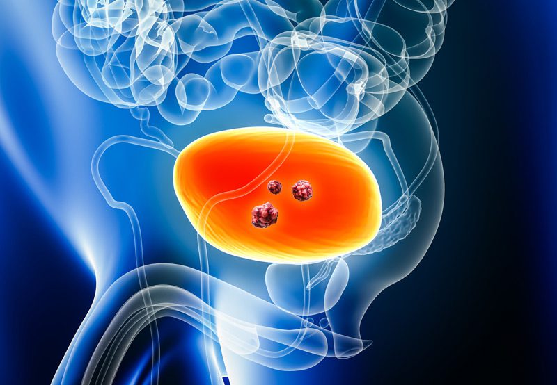View-of-bladder-with-malignant-tumor-cells