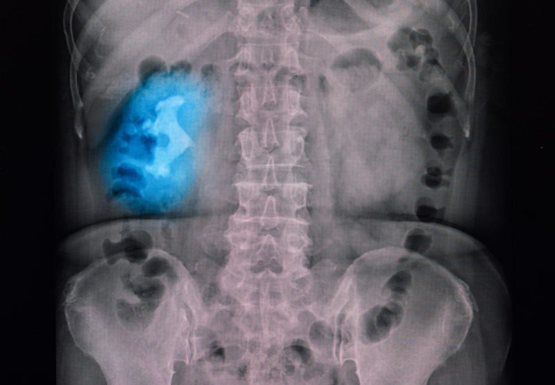 X-ray-showing-large-staghorn-kidney-stone X-ray-showing-large-staghorn-kidney-stone