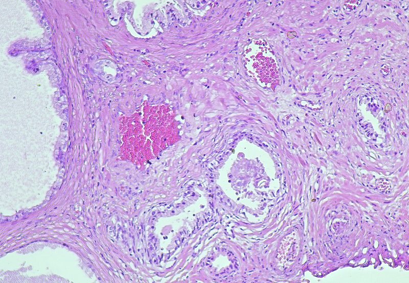 photomicrograph-showing-histological-features-of-benign-prostatic-hyperplasia photomicrograph-showing-histological-features-of-benign-prostatic-hyperplasia